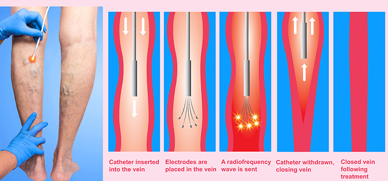 Steps of radiofrequency ablation treatment for varicose veins