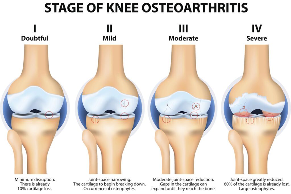 Stages of knee Osteoarthritis (OA). Kellgren and Lawrence criteria for assessment stage of osteoarthritis. The classifications are based on osteophyte formation and joint space narrowing.