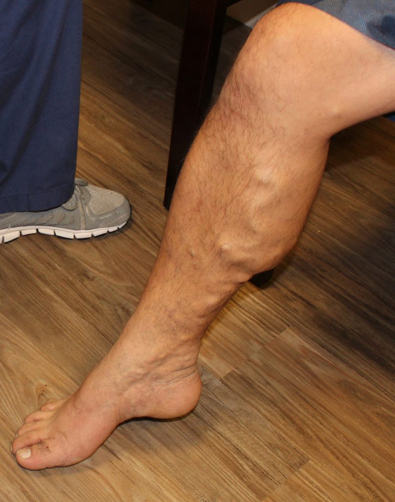 A man's leg with prominent varicose veins.