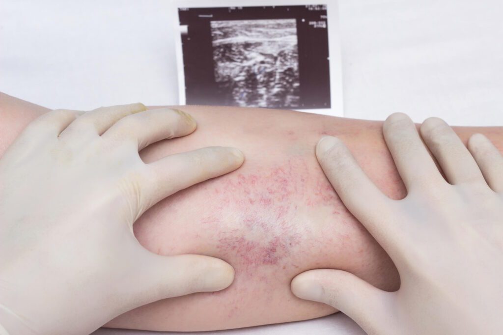 A doctor in medical gloves is examining a patient's leg with a visible bruise and swelling, likely indicative of a blood clot. An ultrasound image of the leg is visible in the background