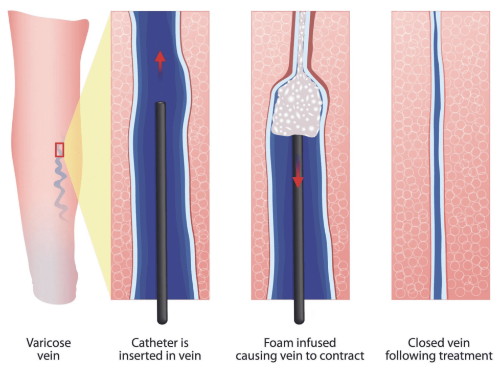 A medical illustration depicting the process of microfoam ablation for treating varicose veins