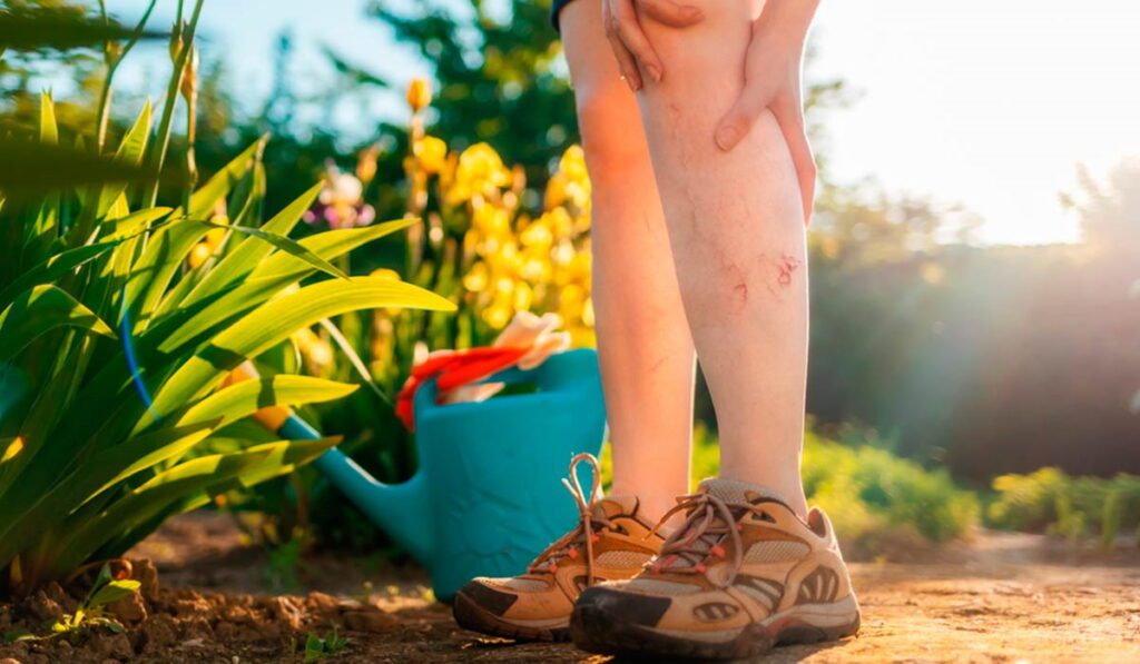 A young girl with noticeable leg swelling, seeking relief for her condition.