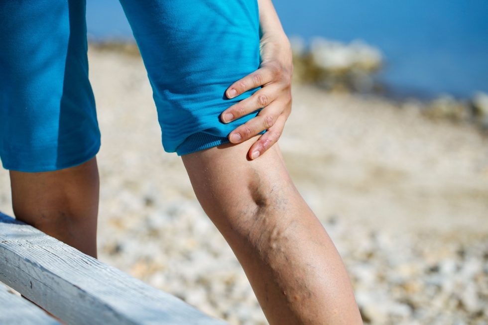 A person wearing blue shorts is standing on a beach, holding their leg with their hand. Visible on their leg are enlarged, twisted veins, indicating varicose veins.