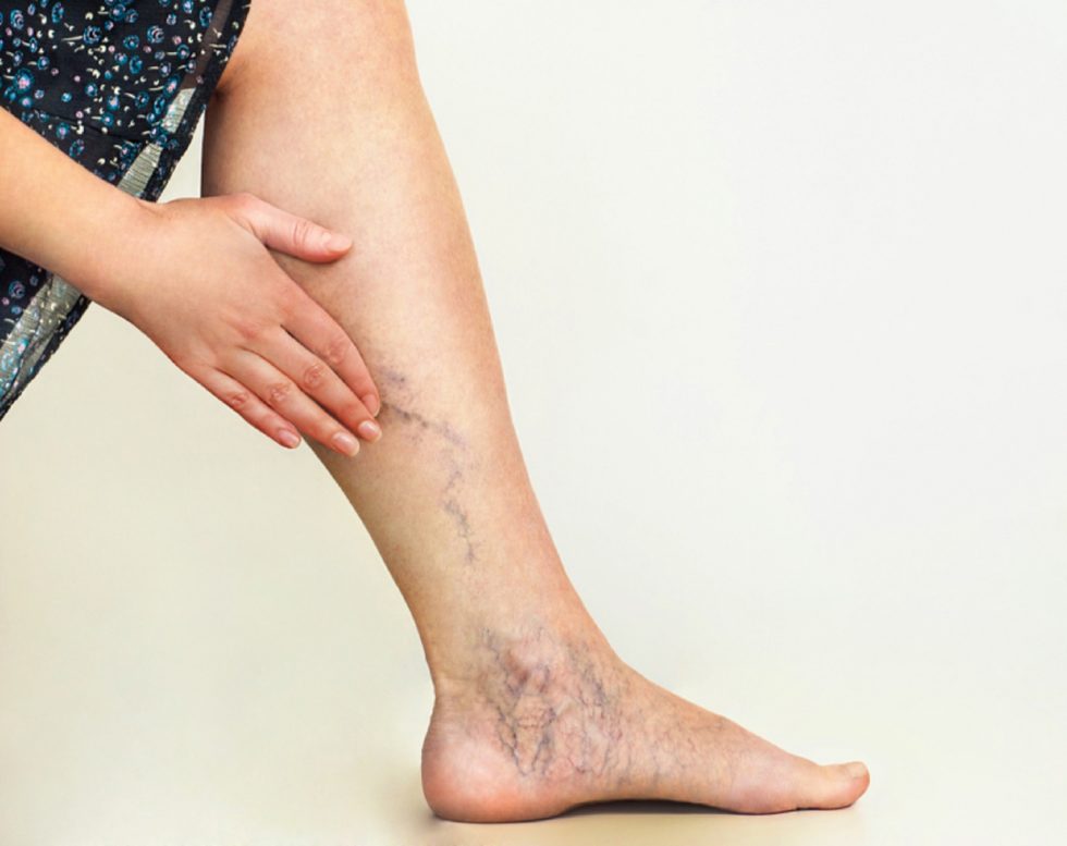 A close-up of varicose veins on a leg, showing the characteristic blue and purple appearance.