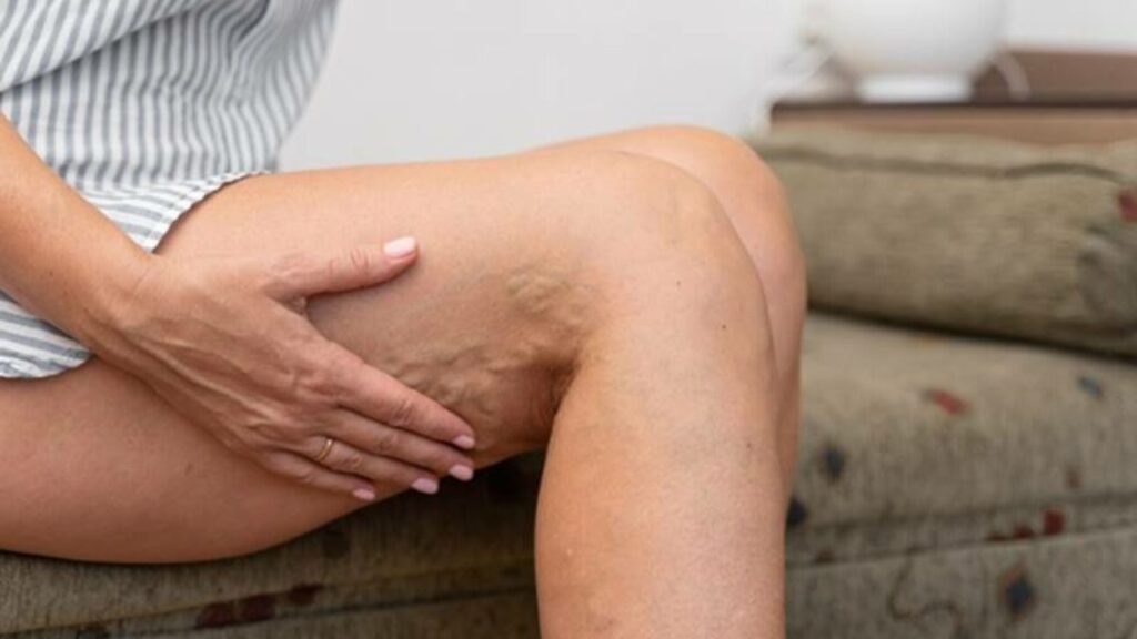 Varicose veins treatment woman at home