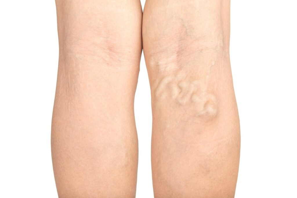 A close-up of a woman's legs showing varicose veins, which are enlarged, twisted veins. The veins are most prominent behind the knees.