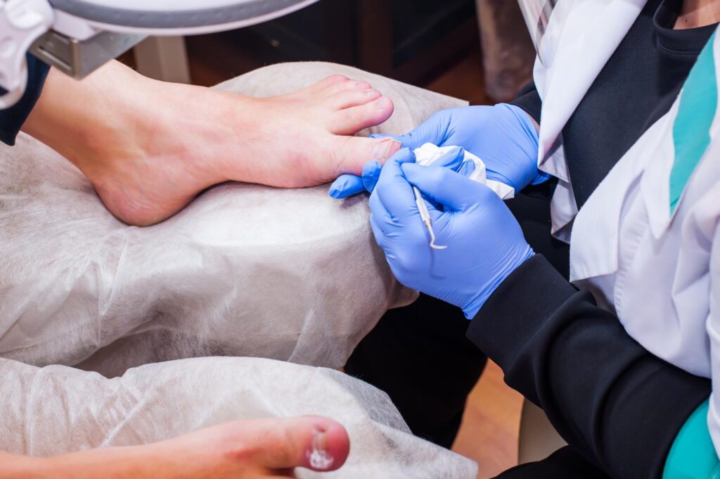 Podology treatment. Podiatrist treating toenail fungus. Doctor removes calluses, corns and treats ingrown nail. Hardware manicure. Health, body care concept. Selective focus.