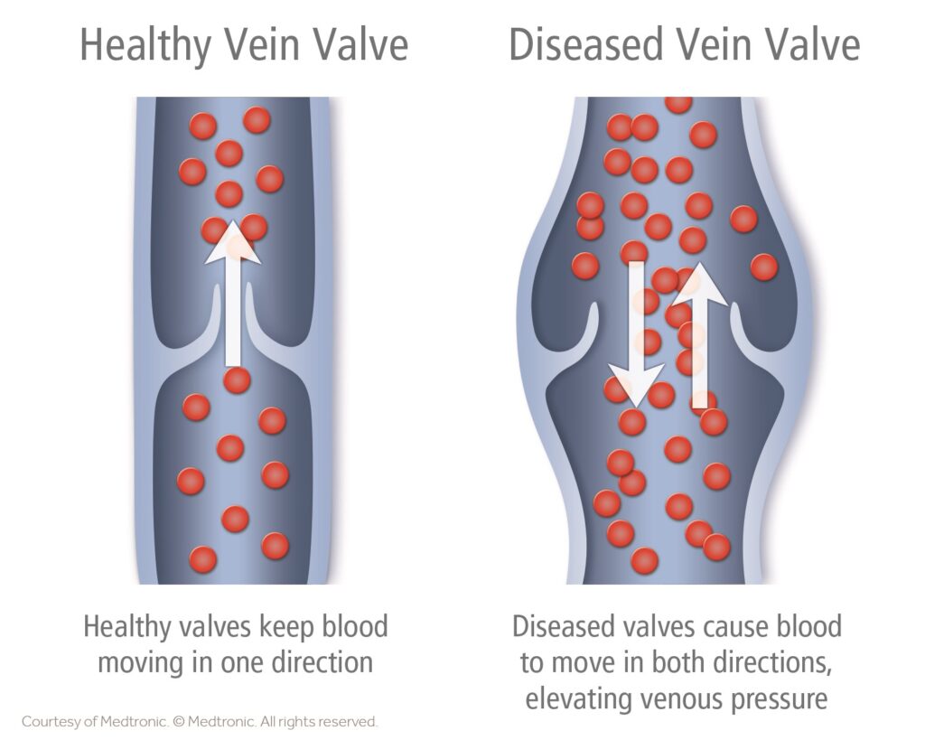 Heathy vaves keep bllod moving in one direction, Diseased valves casue blood to move in both directions'eleveating venous pressure