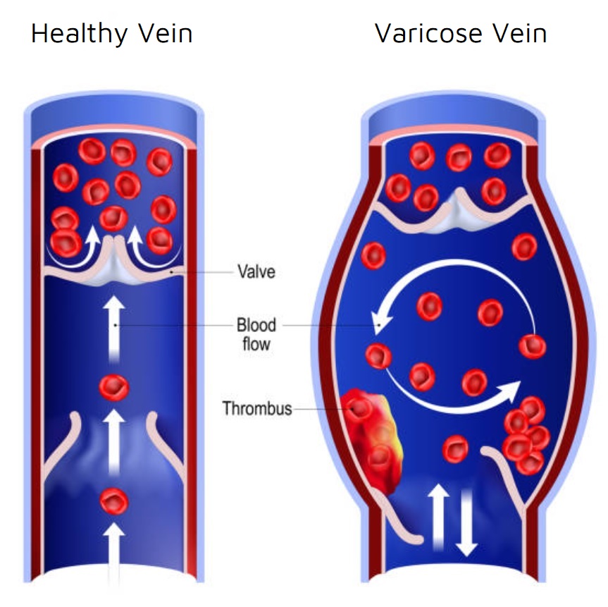 Vein problems_Healthy Vein and Varicose Vein