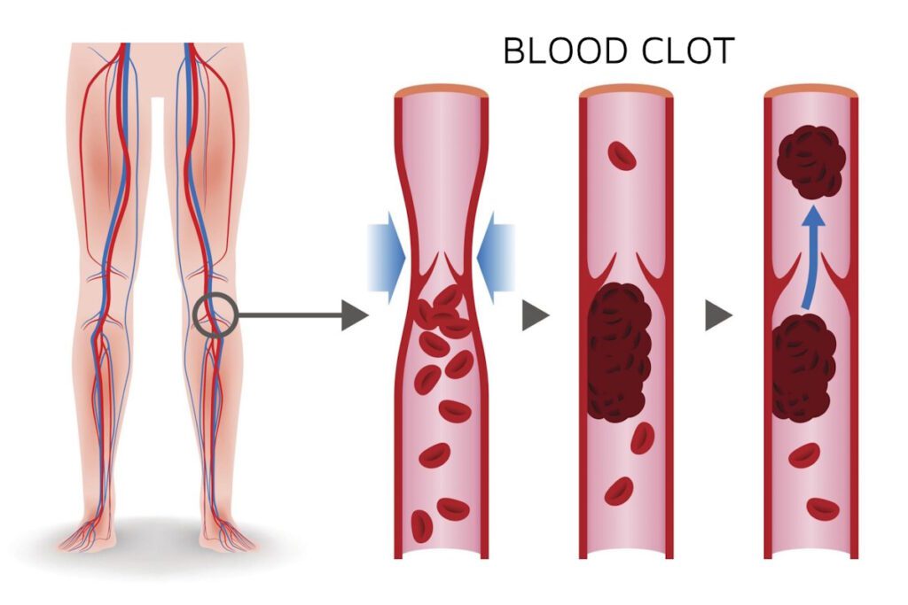 Vein thrombosis blood clot illustration deep vein thrombosis