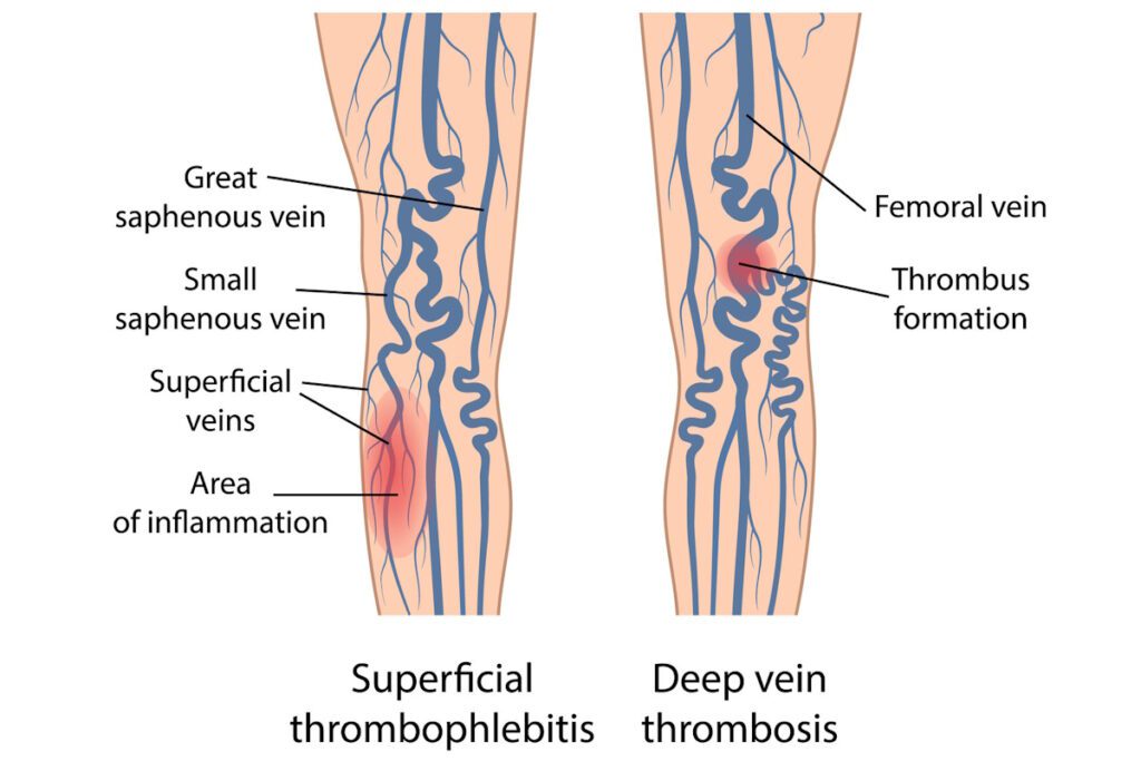 Vein thrombosis Blood Clot Superficial Thrombophlebitis Legs Deep Vein