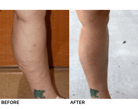 Leg vein treatment results: Before and after.