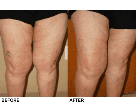 Comparison of legs before and after treatment for spider veins.