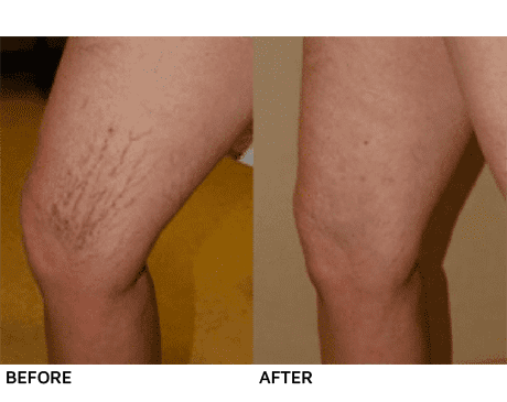 Before and after photos showcasing the effectiveness of spider vein treatment. The veins are noticeably less prominent in the after image.