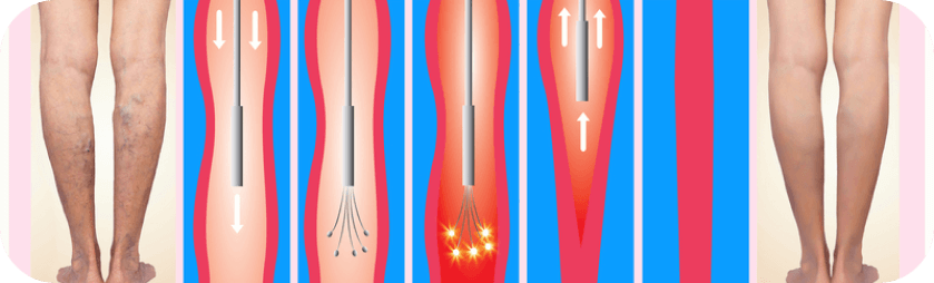 Laser Ablation