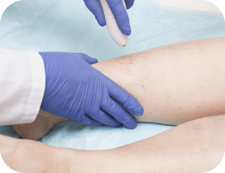 Laser Ablation Treatment