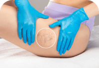 Close-up image of a medical procedure being performed on a patient's thigh