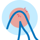 A simplified diagram of a person with a red, painful area on their back, with lightning bolts indicating pain or tingling.