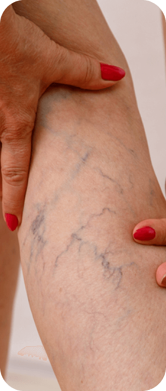 Varicose veins treatment