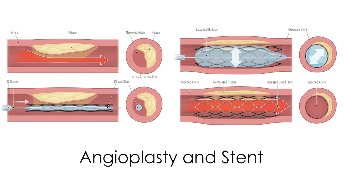 Angioplasty and stent illustration