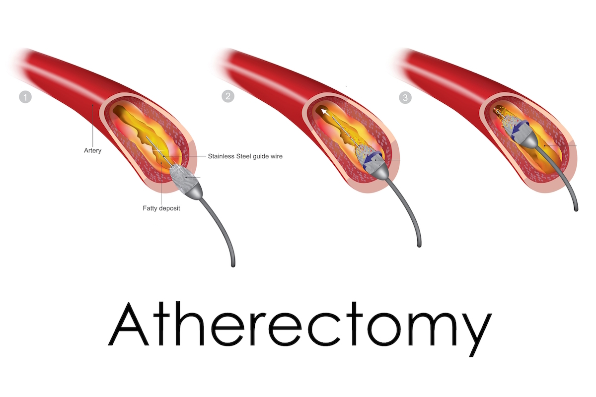 Atherectomy and Angioplasty illustration