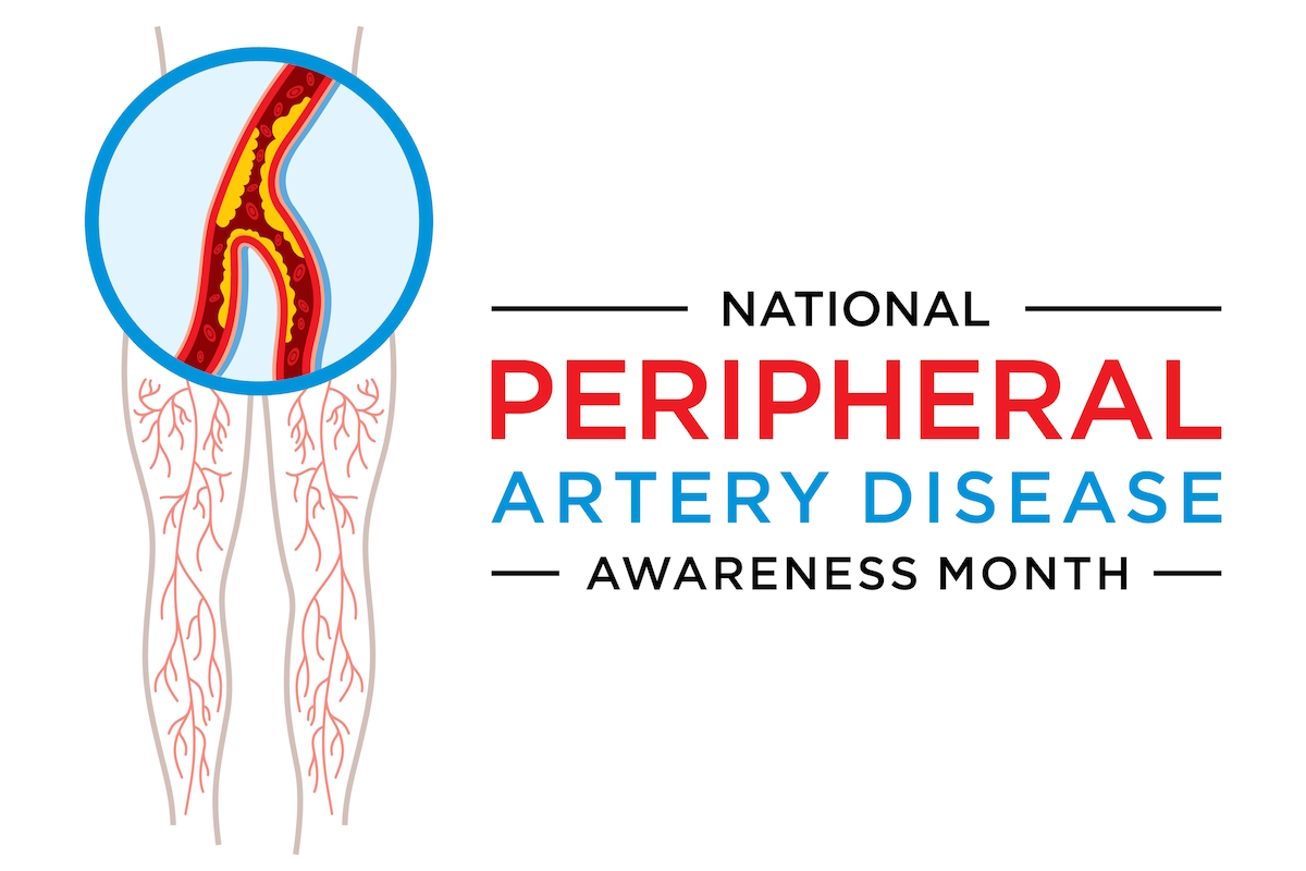 Atherectomy - Peripheral Artery Disease Awareness Month is observed in September