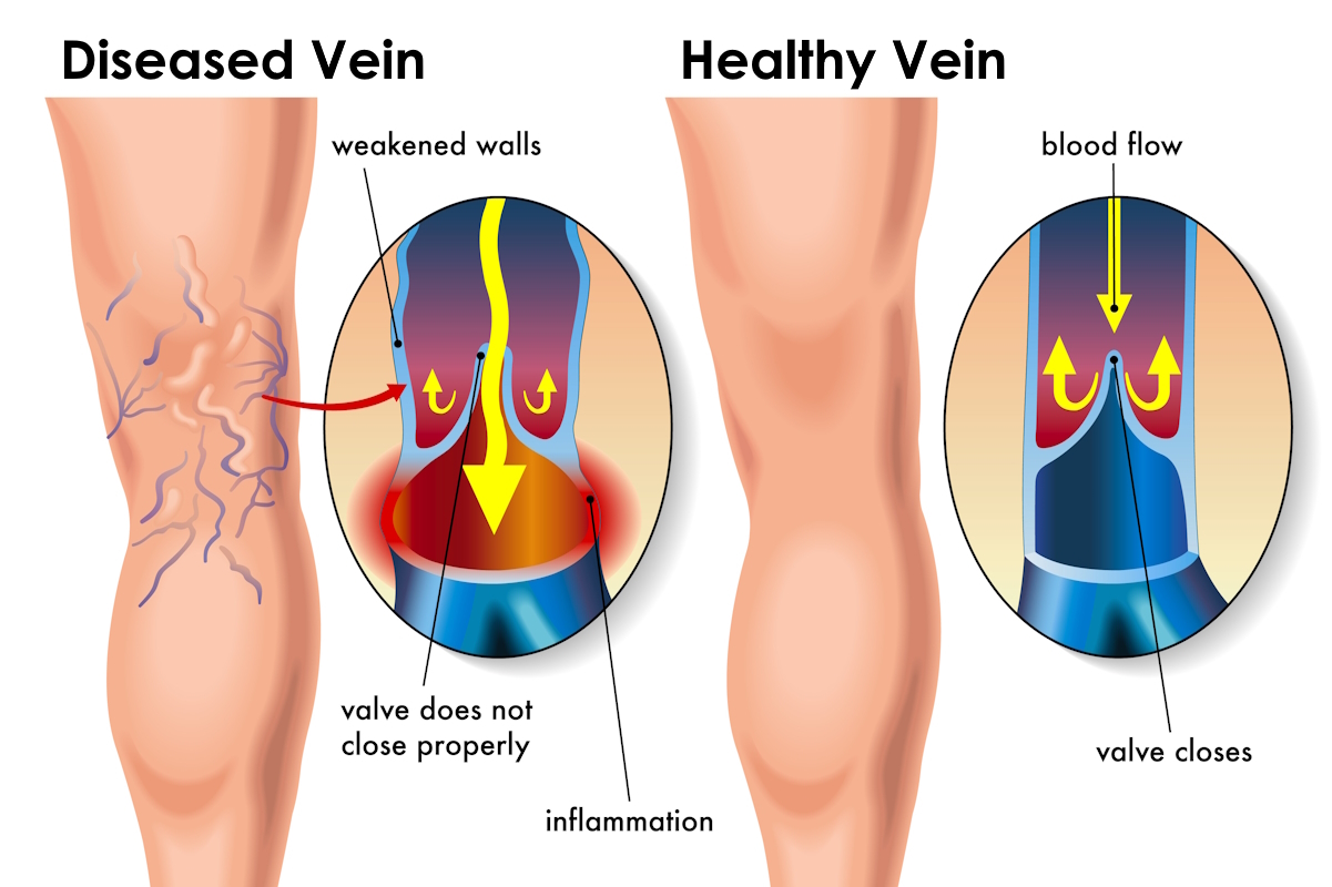 illustration diseased vs healthy vein