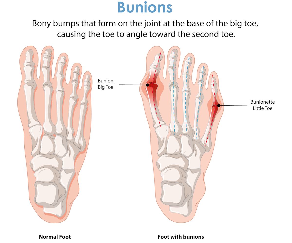 podiatrists foot conditions Bunions: Causes and Effects