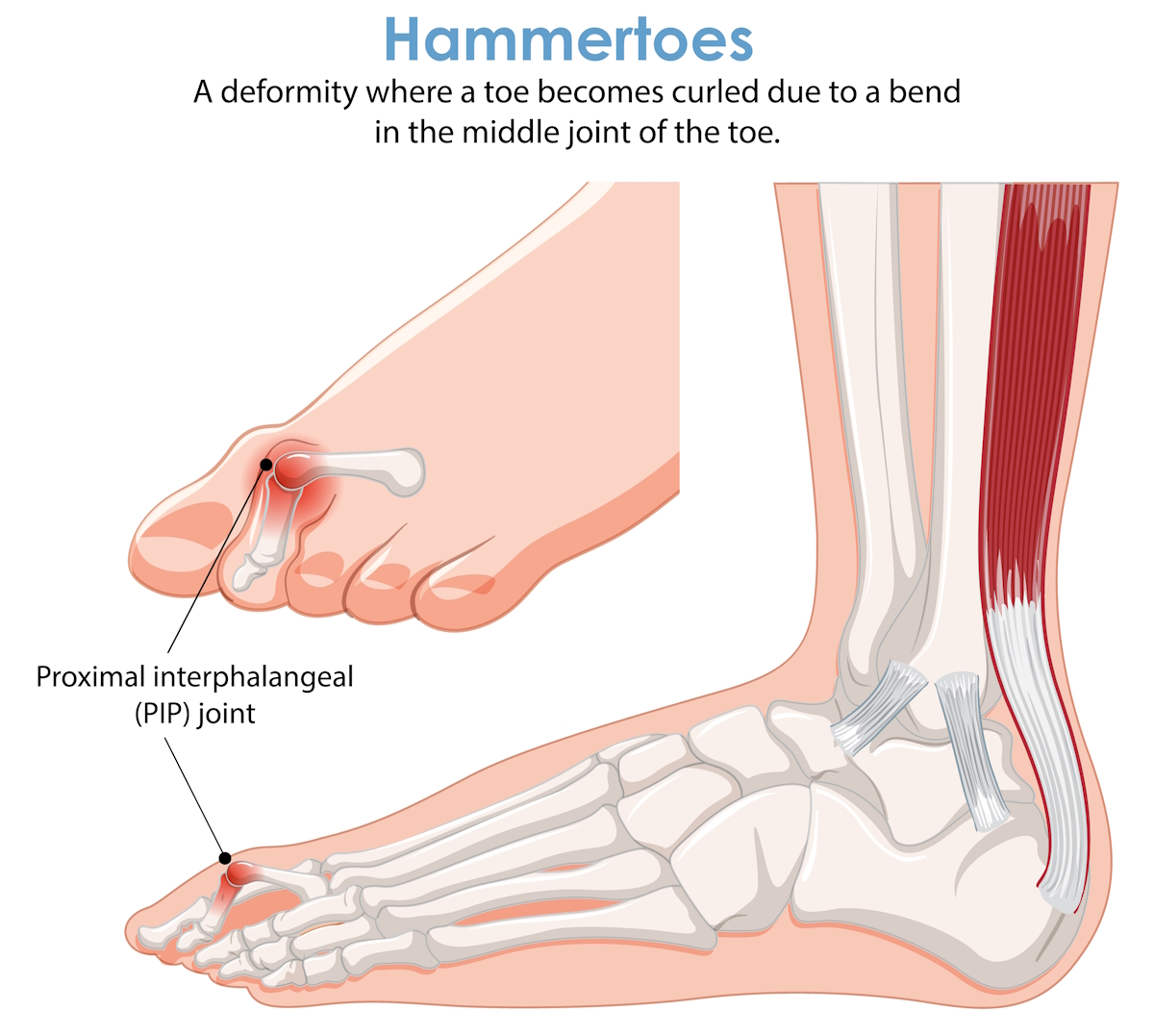 podiatrists foot conditions Hammer Toe Medical Illustration