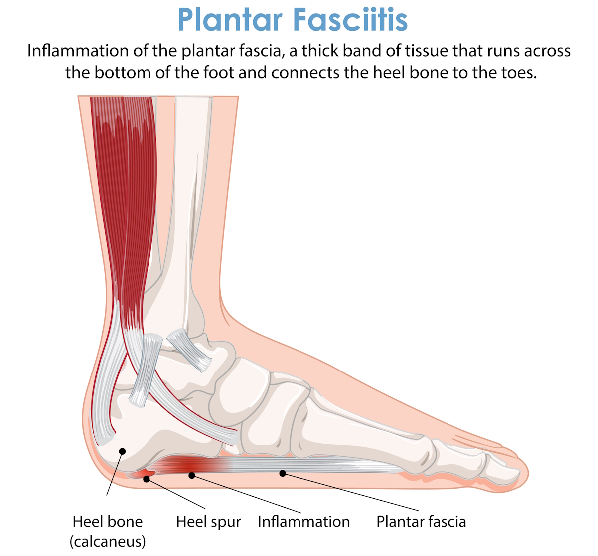 podiatrists foot conditions Plantar Fasciitis Medical Illustration