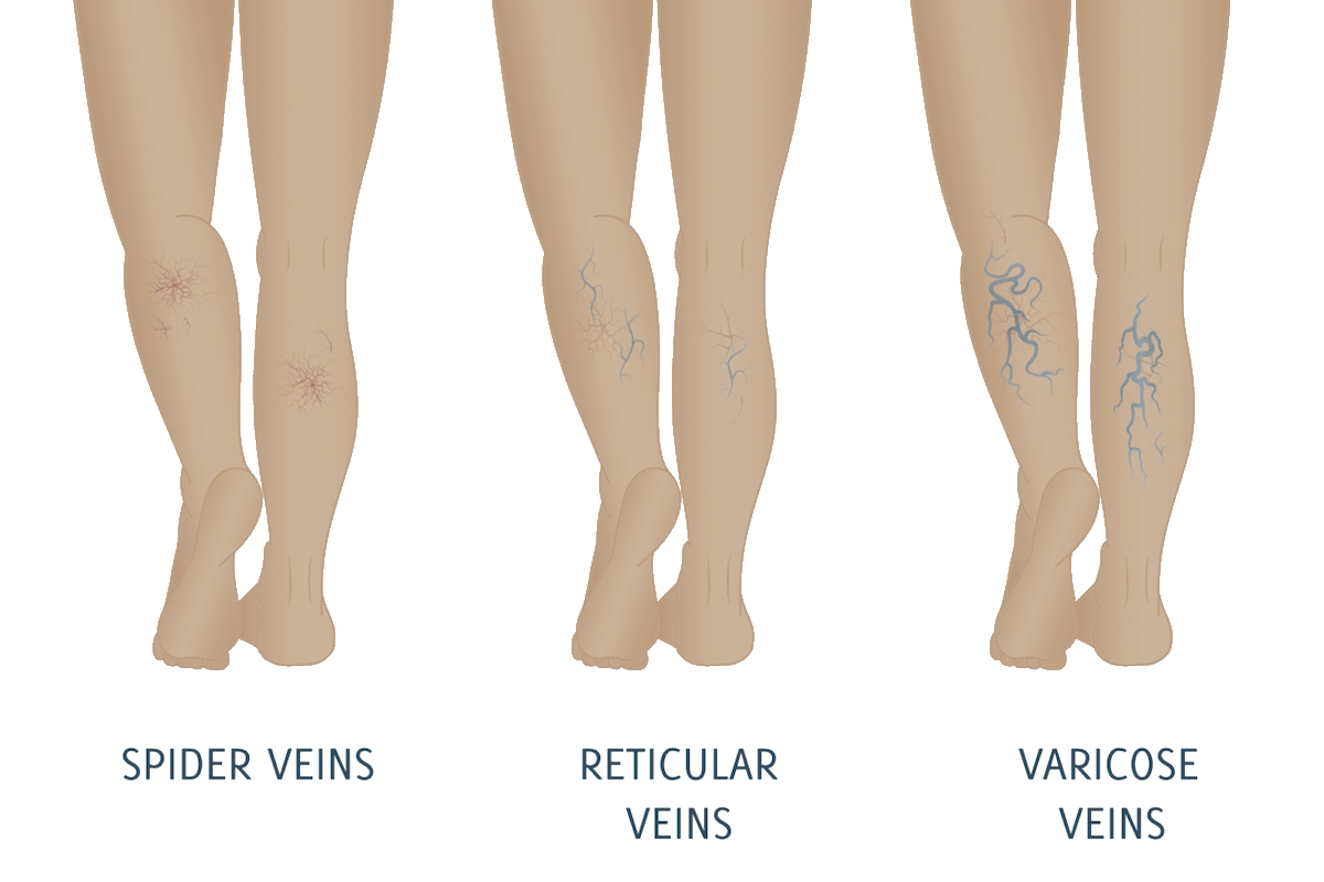 varicose veins reticular spider types of veins