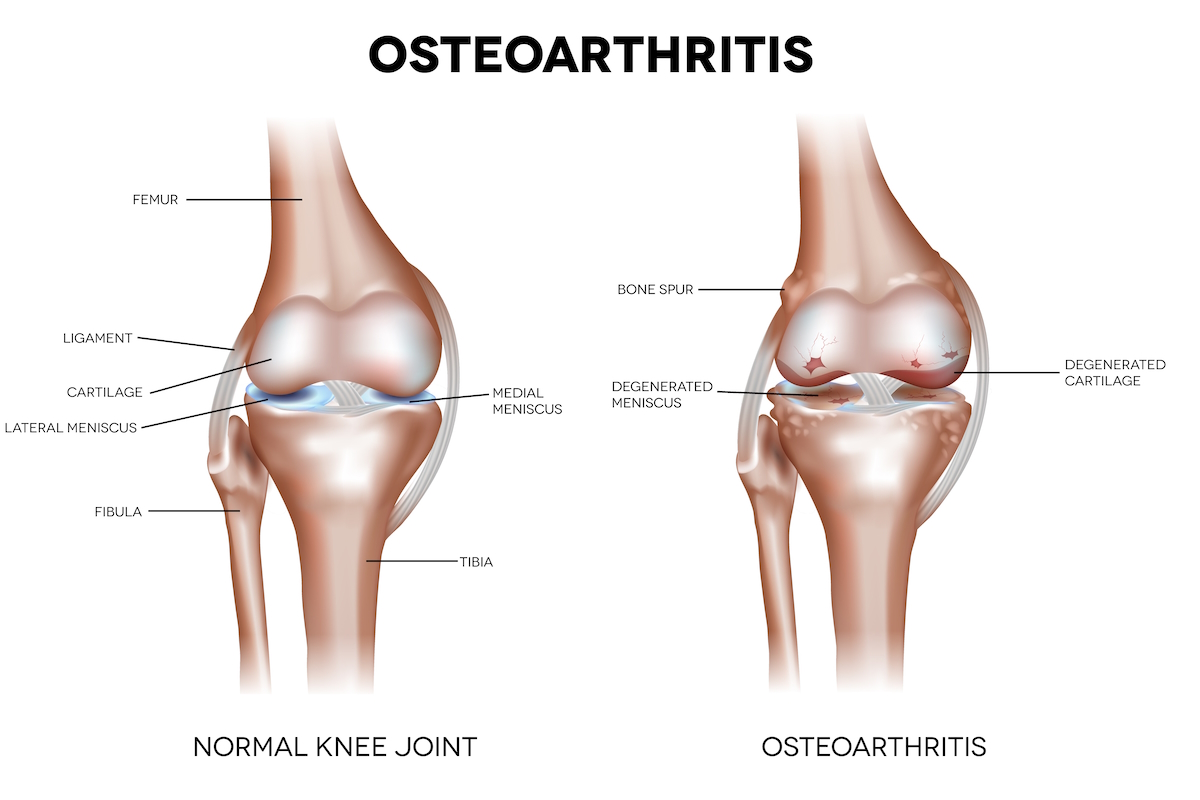 knee pain illustration osteoarthritis